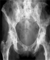 Parietal Bone Metastasis of Rectal Adenocarcinoma as an Initial Diagnosis of Recurrence: Case Report