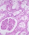 Urinary Beta2-Microglobulin is a Sensitive Indicator for Renal Tubular Injury