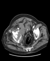 Case Report: Transient Global Aphasia Due to Pulmonary Embolism