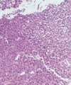 Sarcomatoid Carcinoma of Larynx: Case report