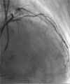 Stent Fracture Following Recanalization of a Totally Occluded Artery: A Word of Caution