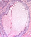 Tubular Apocrine Adenoma - Case Report and Systematic Review