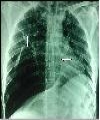 A Rare Case of Vanishing Lung Syndrome