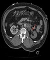 Traumatic Dissection and Thrombosis of the Mid Renal Artery with Endovascular Repair and Review of the Literature