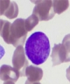 Early Peripheral Blood Blast Clearance: A New Chemosensitivity Indicator for Acute Myeloid Leukemia