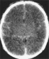 Severe Hypoglycemic Coma Event on MRI: Specific Brain Necrosis