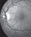 Transient Drug-Induced Myopia