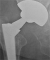 Acetabular Reconstruction Using Massive Allografts for Combined Cavitary and Segmental Defects