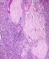 Reactive Amyloidosis in a middle aged female with Behcet’s disease – Case report