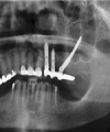 Use of Zygomatic Implants for Atrophic Maxilla Rehabilitation - A Clinical Case Report of Unilateral Zygomatic Implant
