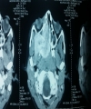 Endoscopic Excision of Juvenile Nasopharyngeal Angiofibroma: A Case Series