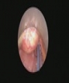 Vallecular Cyst in a 1 Month Old Infant